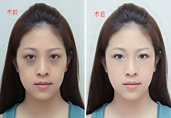 超声波去眼袋的原理是什么 超声波去眼袋的果如何