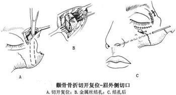 常见的颧骨整形术式 颧骨整形手术果怎么样