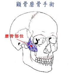 常见的颧骨整形术式 颧骨整形手术果怎么样