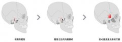 双侧颧骨截骨缩窄降低手术
