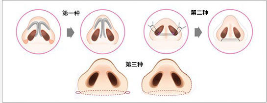 鼻翼缩小手术是怎么做的 鼻翼缩小手术有后遗症吗