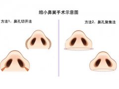 鼻翼缩小手术是怎么做的 鼻翼缩小手术有后遗症吗