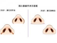 鼻翼缩小手术是怎么做的 鼻翼缩小手术有后遗症吗 鼻翼缩小手术是怎么做的 鼻翼缩小手术有后遗症吗