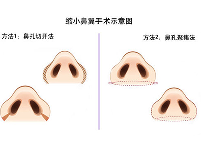 鼻翼缩小手术是怎么做的 鼻翼缩小手术有后遗症吗