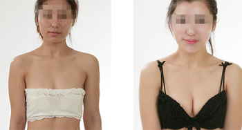 假体隆胸是怎么做的 假体隆胸后多久能哺乳
