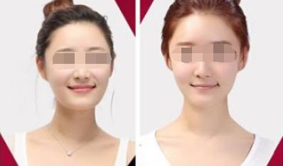 丰下巴用假体的好吗 假体丰下巴果自然吗