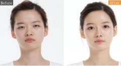 做双眼皮手术痛不痛 双眼皮手术后该如何护理