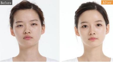 做双眼皮手术痛不痛 双眼皮手术后该如何护理