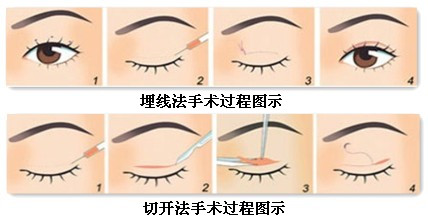 做双眼皮手术痛不痛 双眼皮手术后该如何护理