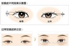 割双眼皮手术后多久能恢复 割双眼皮手术怎么护理