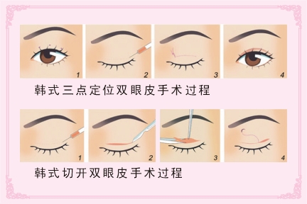 割双眼皮手术后多久能恢复 割双眼皮手术怎么护理