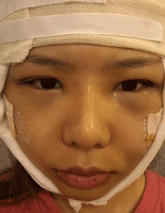 双眼皮修复 下巴矫正 磨骨手术对比照片 我已经爱上自拍了