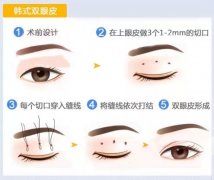 双眼皮手术失败会如何