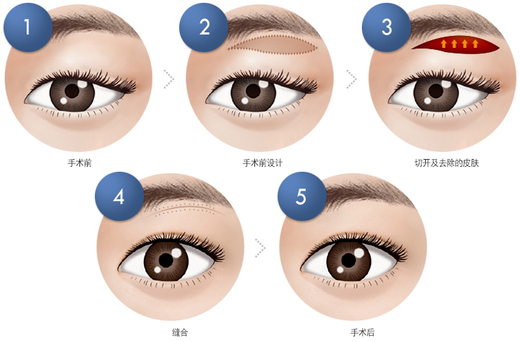 切眉术后如何快速消肿