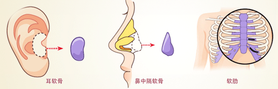 自体耳软骨隆鼻是怎么做的 自体耳软骨隆鼻有没有年龄限制