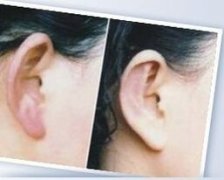 耳廓再造是什么 耳廓再造前后对比照