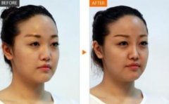 玻尿酸注射隆鼻有副作用吗 玻尿酸注射隆鼻后遗症是什么
