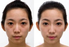 激光去眼袋多少钱 激光去眼袋前后对比图 激光去眼袋多少钱 激光去眼袋前后对比图