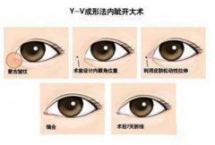 开眼角手术有后遗症吗 开眼角手术有什么后遗症 开眼角手术有后遗症吗 开眼角手术有什么后遗症