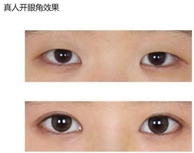 开眼角手术有后遗症吗 开眼角手术有什么后遗症