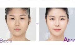 埋线双眼皮能保持多久 埋线双眼皮后双眼皮为什么会消失