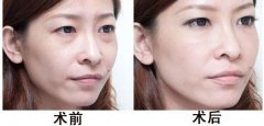 简单有去眼袋的方法有哪些 简单有去眼袋的方法有哪些