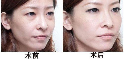 简单有去眼袋的方法有哪些