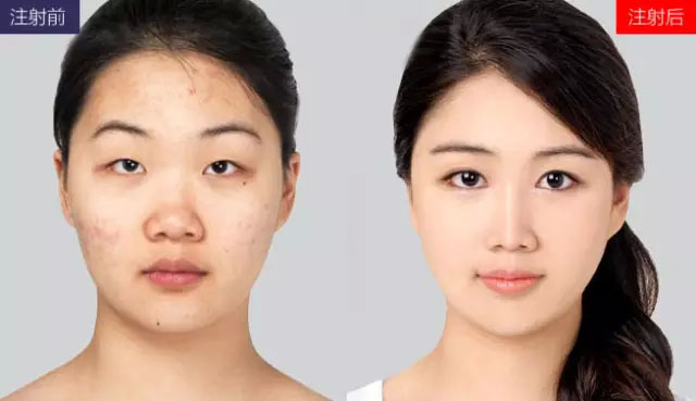自体脂肪丰下巴一般需要多少钱
