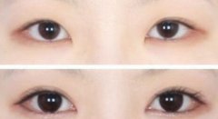 双眼皮失败了怎么办 双眼皮失败后如何修复