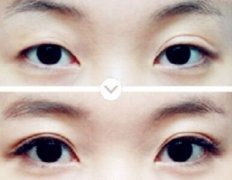 埋线双眼皮失败了怎么办 埋线双眼皮失败修复