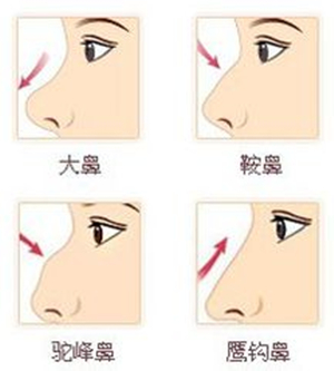 自体软骨隆鼻手术