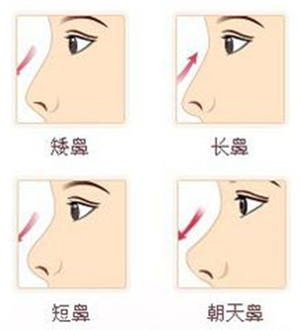 自体软骨隆鼻手术