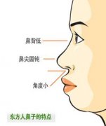 自体软骨隆鼻手术有哪些优点 自体软骨隆鼻手术有哪些优点