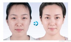 自体脂肪丰太阳穴的原理 自体脂肪丰太阳穴果持久吗
