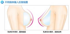 假体隆胸手感如何 假体隆胸术后应注意什么