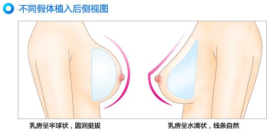 假体隆胸手感如何 假体隆胸术后应注意什么