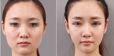 面部吸脂果怎么样,面部吸脂有副作用吗