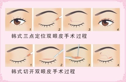 韩国割双眼皮的成好吗 割双眼皮后眼睛肿胀怎么办