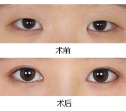 割双眼皮手术
