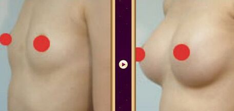 假体隆胸后能哺乳吗,假体隆胸能保持多少年