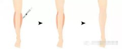 注射注射瘦腿、小腿吸脂、肌肉切除术 你选择哪一个
