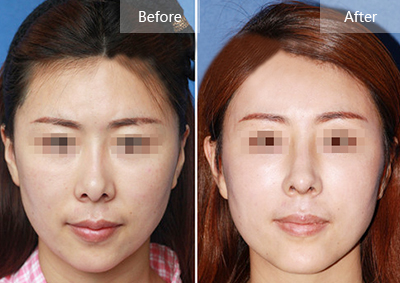 隆鼻手术失败后需要多久才能进行修复