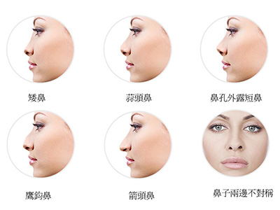 隆鼻手术失败后需要多久才能进行修复