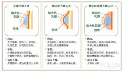 麦格假体好还是曼托假体材料好