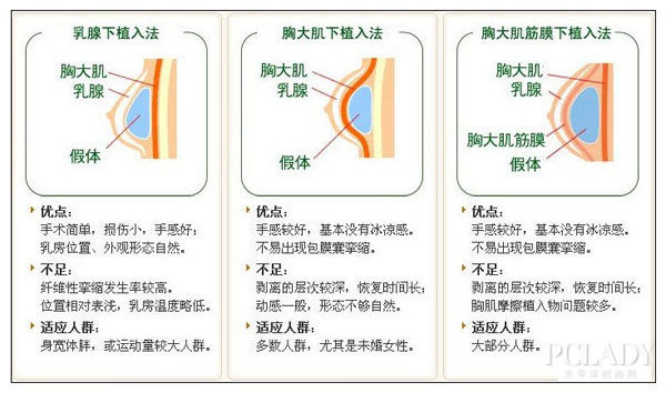 麦格假体好还是曼托假体材料好