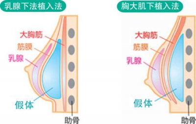 麦格假体好还是曼托假体材料好