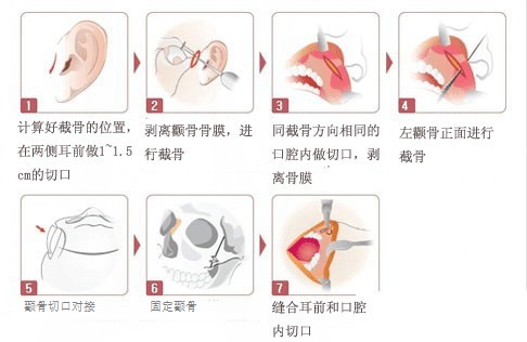 颧骨整形手术类型 颧骨整形手术前后对比图