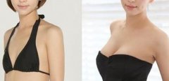 假体隆胸手感怎么样 假体隆胸果自然吗