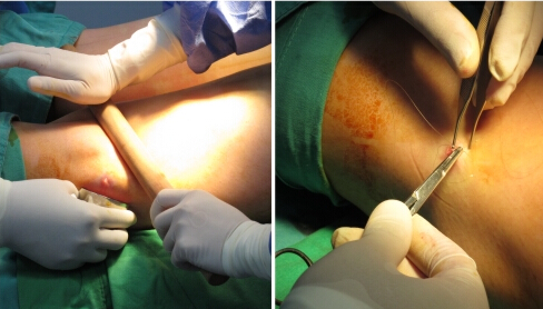 忘了腿部吸脂手术用了多少钱 不过效果很不错