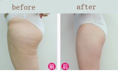 丰臀的手术过程 丰臀手术应注意什么